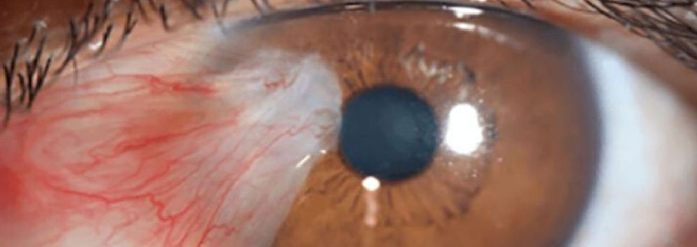 Centre For Sight Africa What to know about PTERYGIUM By Dr. Ehimare Enaholo