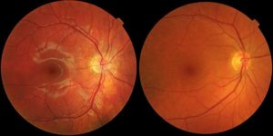 centre-for-sight-africa-age-related-macular-degeneration